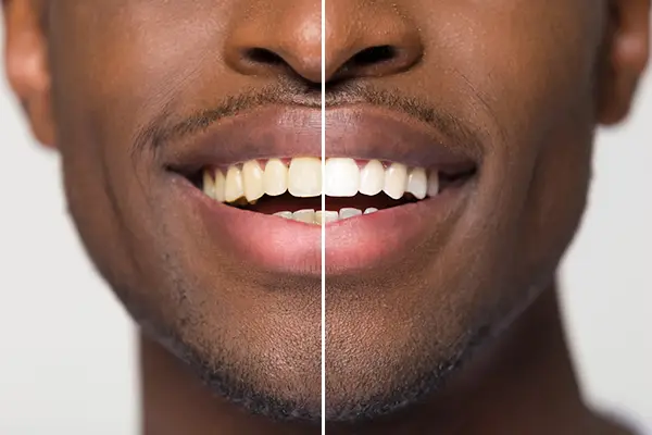Close up comparison of before and after teeth whitening treatment on a man's smile