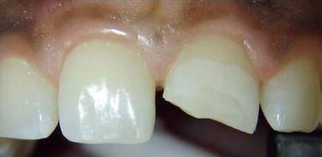 Before Lanier Valley Dentistry treatment