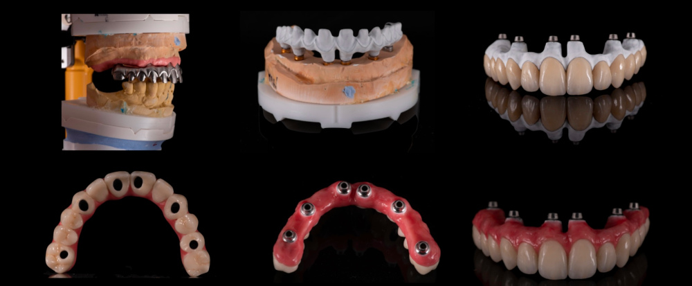 All on X implant supported denture.