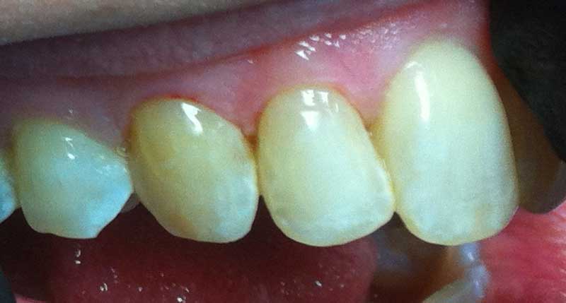 After Lanier Valley Dentistry treatment