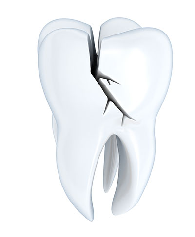 Why Does a Damaged Tooth Need to Be Treated, and How Do Crowns Help?
