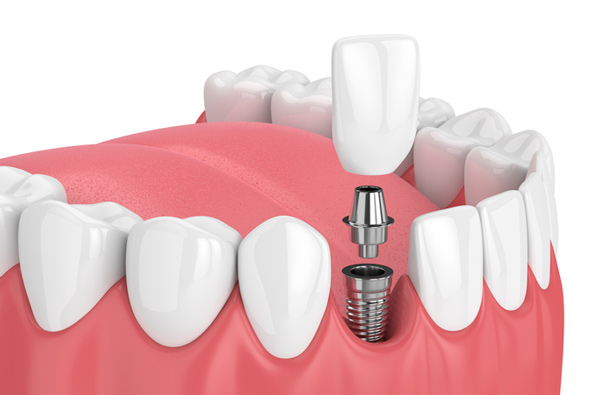 Rendering of jaw with dental implant from Lanier Valley Dentistry in Dacula, GA