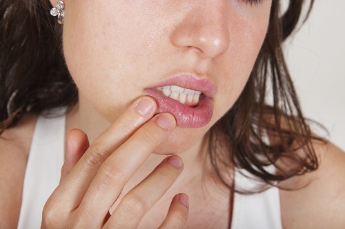 Best Treatments for Canker Sores
