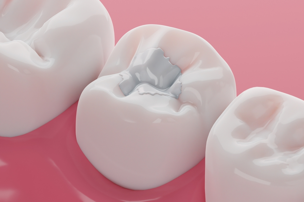 before and after replace amalgams with composite resins