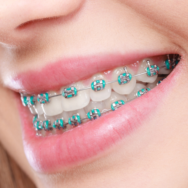 braces dacula