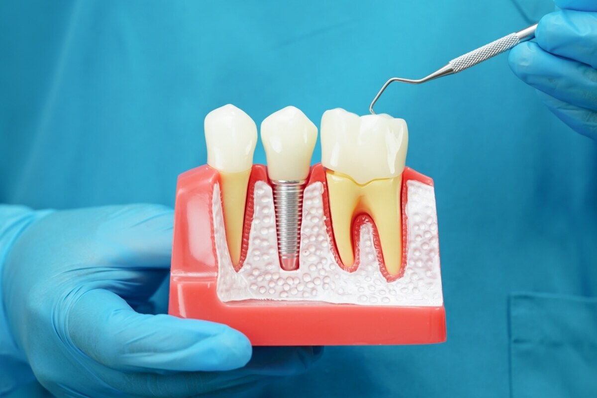 can dental crowns improve your smile here’s how
