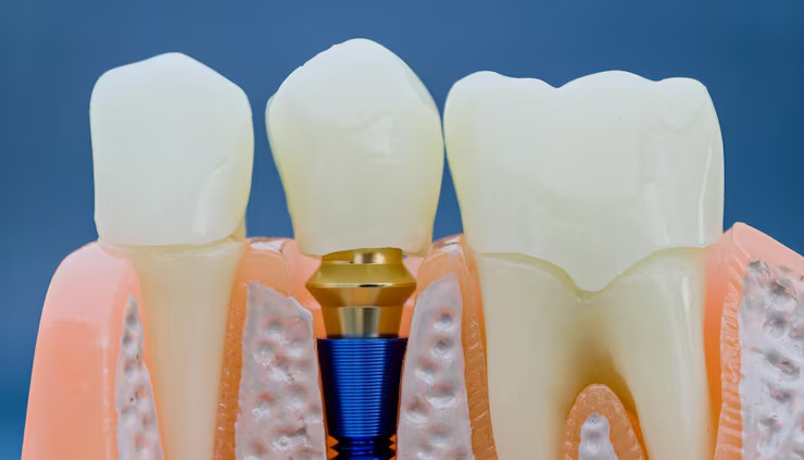 NobelPearl implant shown in the jawbone