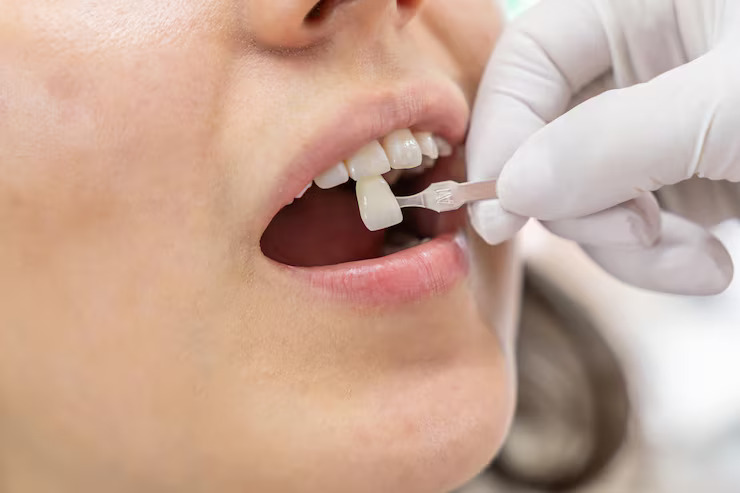 Dentist checking veneers