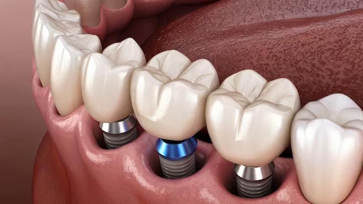 Dental implants with titanium posts